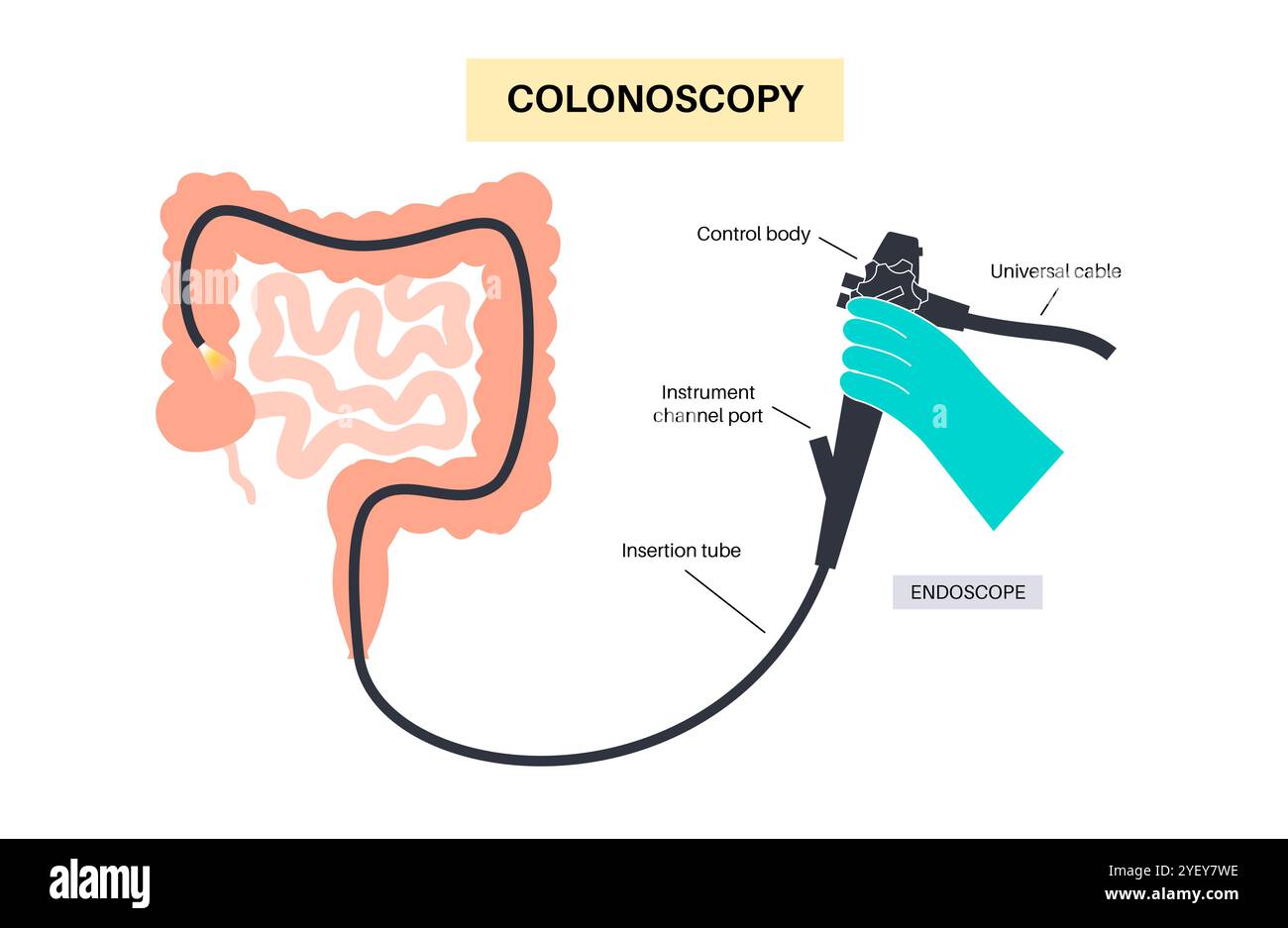 Illustrazione concettuale di una procedura di colonscopia. Questo è un esame dell'interno del vostro intestino crasso, che comprende il colon, il retto e l'ano. Può essere utilizzato per esplorare le possibili cause di dolore addominale, sanguinamento rettale, diarrea cronica e altri problemi gastrointestinali. Viene utilizzato anche per cercare possibili segni di cancro colorettale o polipi. Foto Stock