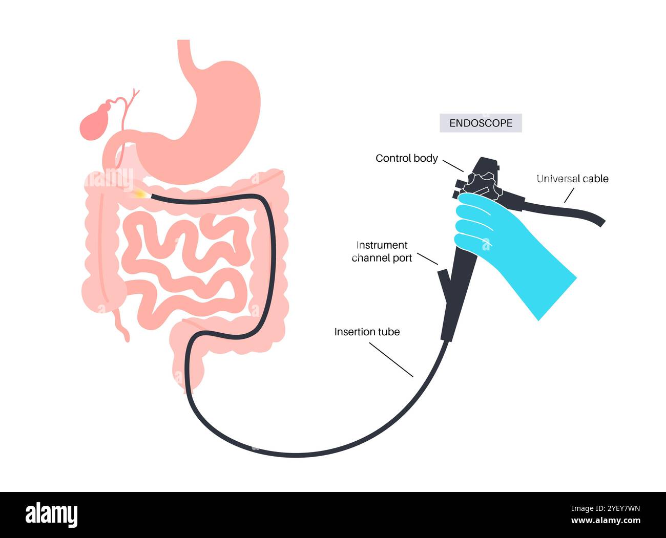 Illustrazione concettuale di una procedura di colonscopia. Questo è un esame dell'interno del vostro intestino crasso, che comprende il colon, il retto e l'ano. Può essere utilizzato per esplorare le possibili cause di dolore addominale, sanguinamento rettale, diarrea cronica e altri problemi gastrointestinali. Viene utilizzato anche per cercare possibili segni di cancro colorettale o polipi. Foto Stock