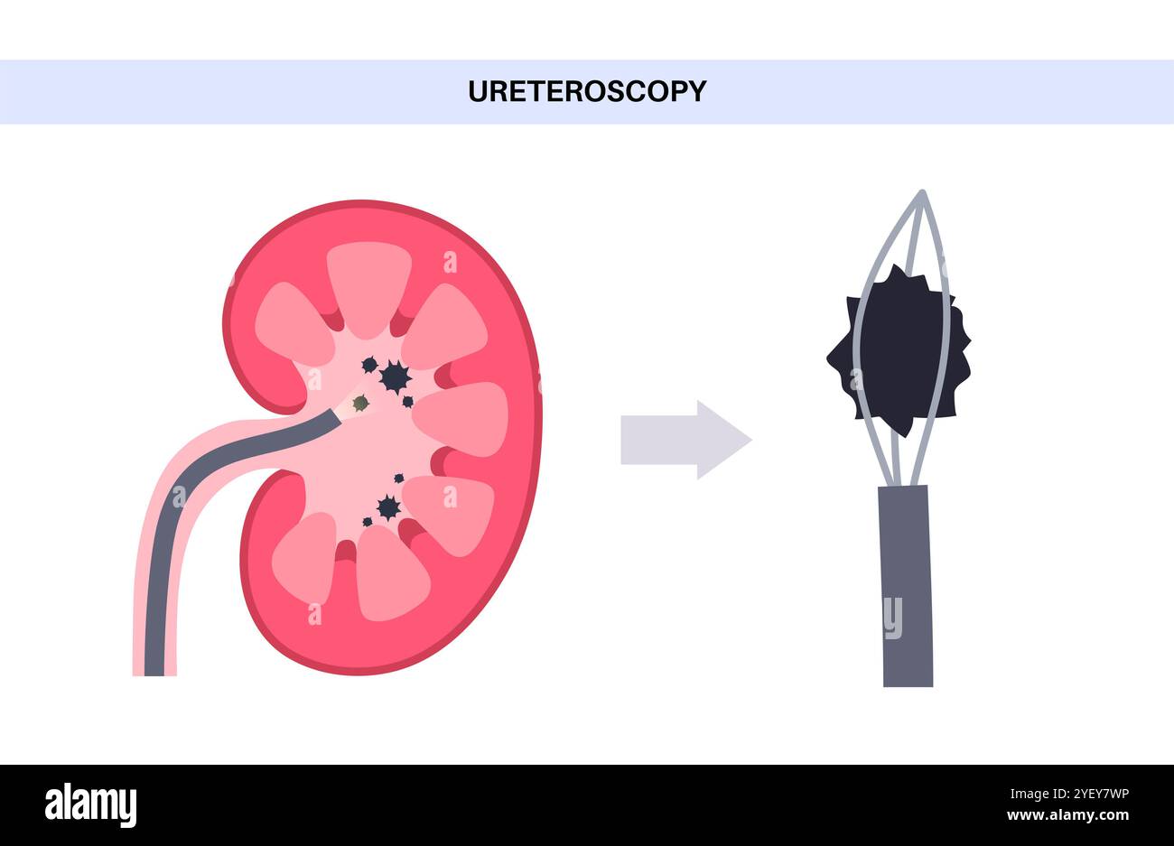 Illustrazione concettuale di una procedura ureteroscopica. Si tratta di una procedura eseguita per esaminare o trattare problemi nel tratto urinario, come i calcoli renali. Foto Stock