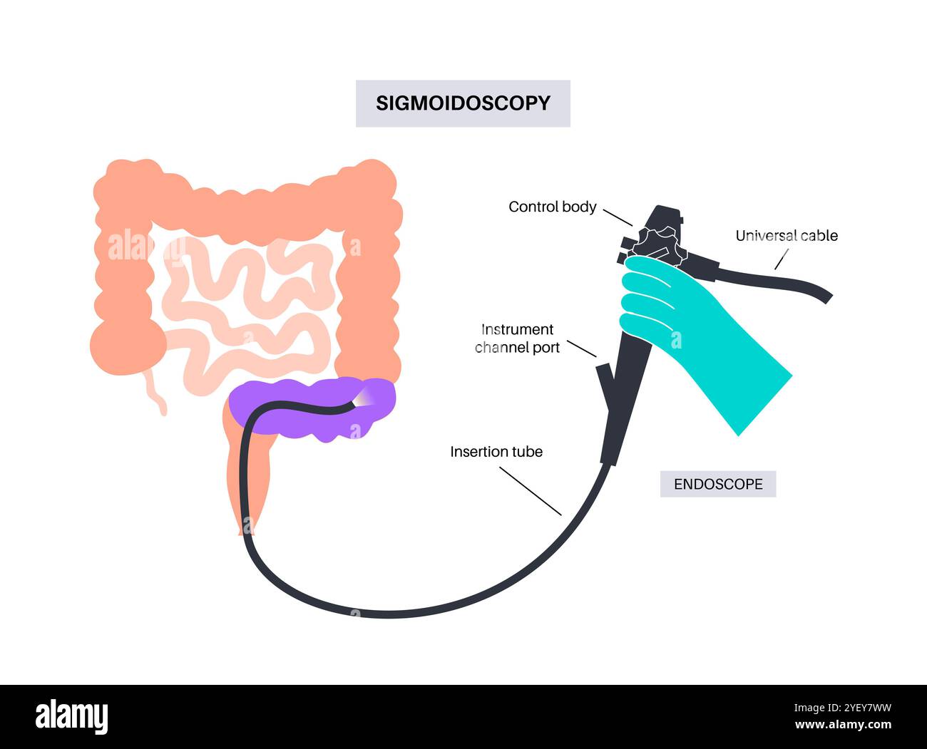 Illustrazione concettuale di una procedura sigmoidoscopica. Si tratta di un test diagnostico utilizzato per controllare il colon sigmoideo, la parte inferiore del colon o l'intestino crasso. La procedura può essere utilizzata per effettuare una biopsia e rimuovere polipi o emorroidi. È anche un test di screening per il cancro del colon e del retto. Foto Stock