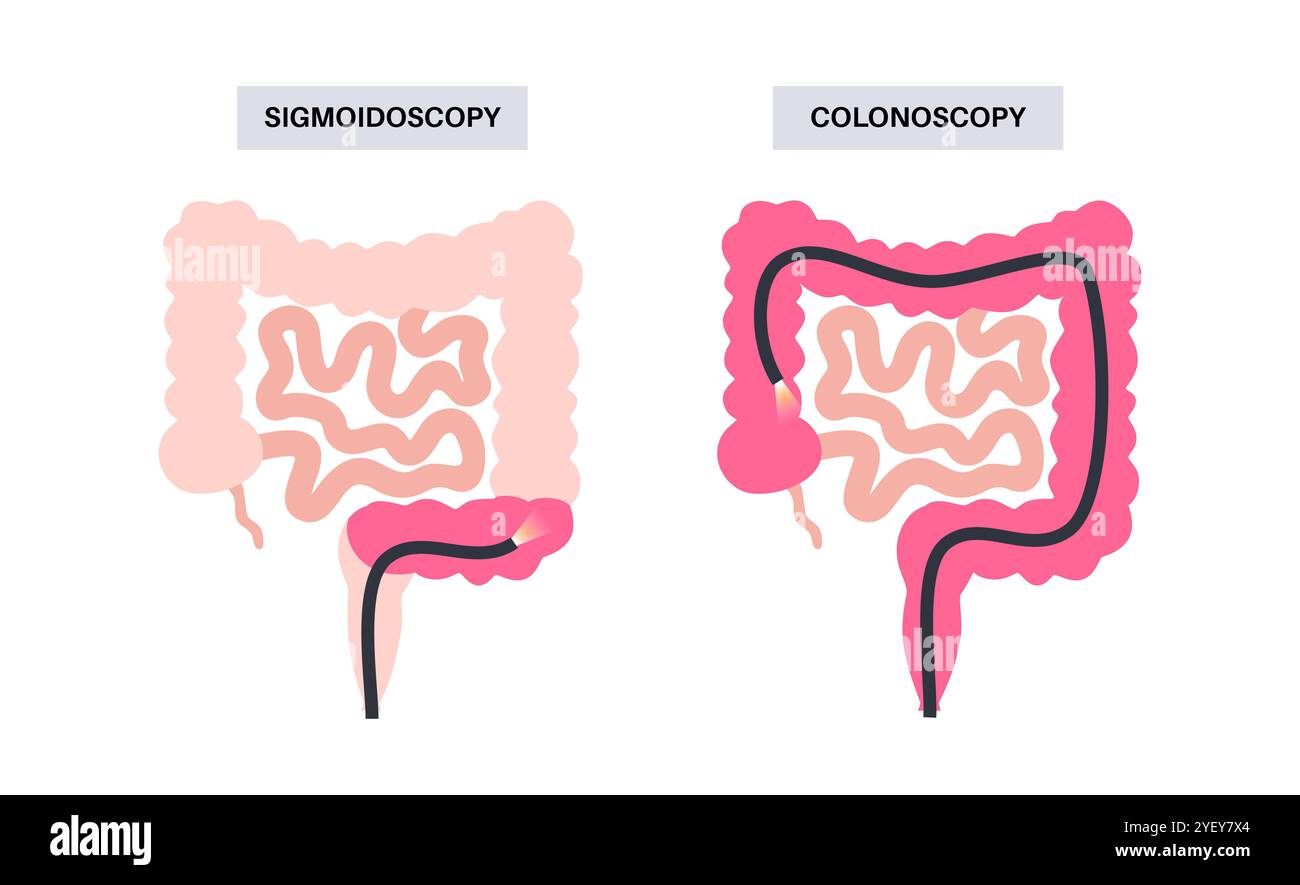 Illustrazione concettuale delle procedure di colonscopia e sigmoidoscopia. Entrambe le procedure cercano aree anomale del colon e del retto. Entrambi utilizzano un tubo sottile e flessibile con una fotocamera e una luce all'estremità per guardare il colon. Una colonscopia esamina l'intero colon, mentre una sigmoidoscopia esamina il colon sigmoideo. Foto Stock