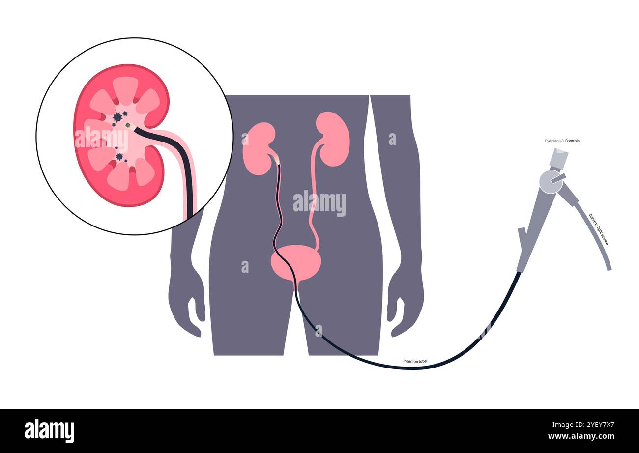 Illustrazione concettuale di una procedura ureteroscopica. Si tratta di una procedura eseguita per esaminare o trattare problemi nel tratto urinario, come i calcoli renali. Foto Stock