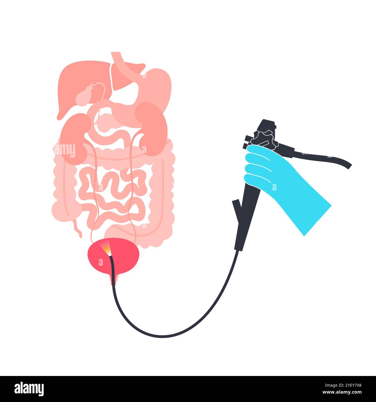 Illustrazione concettuale di una procedura di cistoscopia. Si tratta di una procedura utilizzata per diagnosticare, monitorare e trattare le condizioni che interessano la vescica e l'uretra. Foto Stock