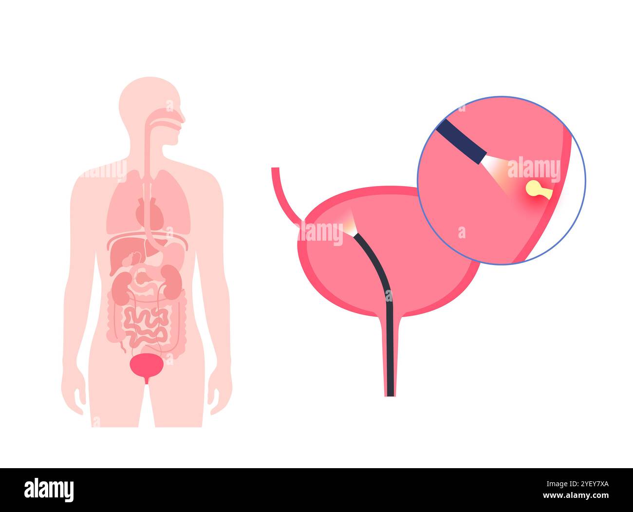 Illustrazione concettuale di una procedura di cistoscopia. Si tratta di una procedura utilizzata per diagnosticare, monitorare e trattare le condizioni che interessano la vescica e l'uretra. Foto Stock