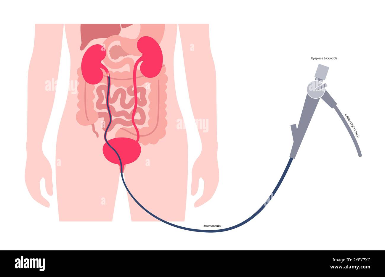 Illustrazione concettuale di una procedura ureteroscopica. Si tratta di una procedura eseguita per esaminare o trattare problemi nel tratto urinario, come i calcoli renali. Foto Stock
