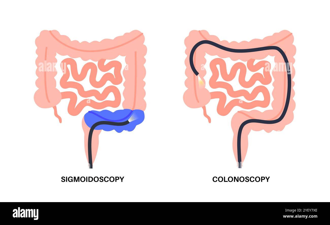 Illustrazione concettuale delle procedure di colonscopia e sigmoidoscopia. Entrambe le procedure cercano aree anomale del colon e del retto. Entrambi utilizzano un tubo sottile e flessibile con una fotocamera e una luce all'estremità per guardare il colon. Una colonscopia esamina l'intero colon, mentre una sigmoidoscopia esamina il colon sigmoideo. Foto Stock