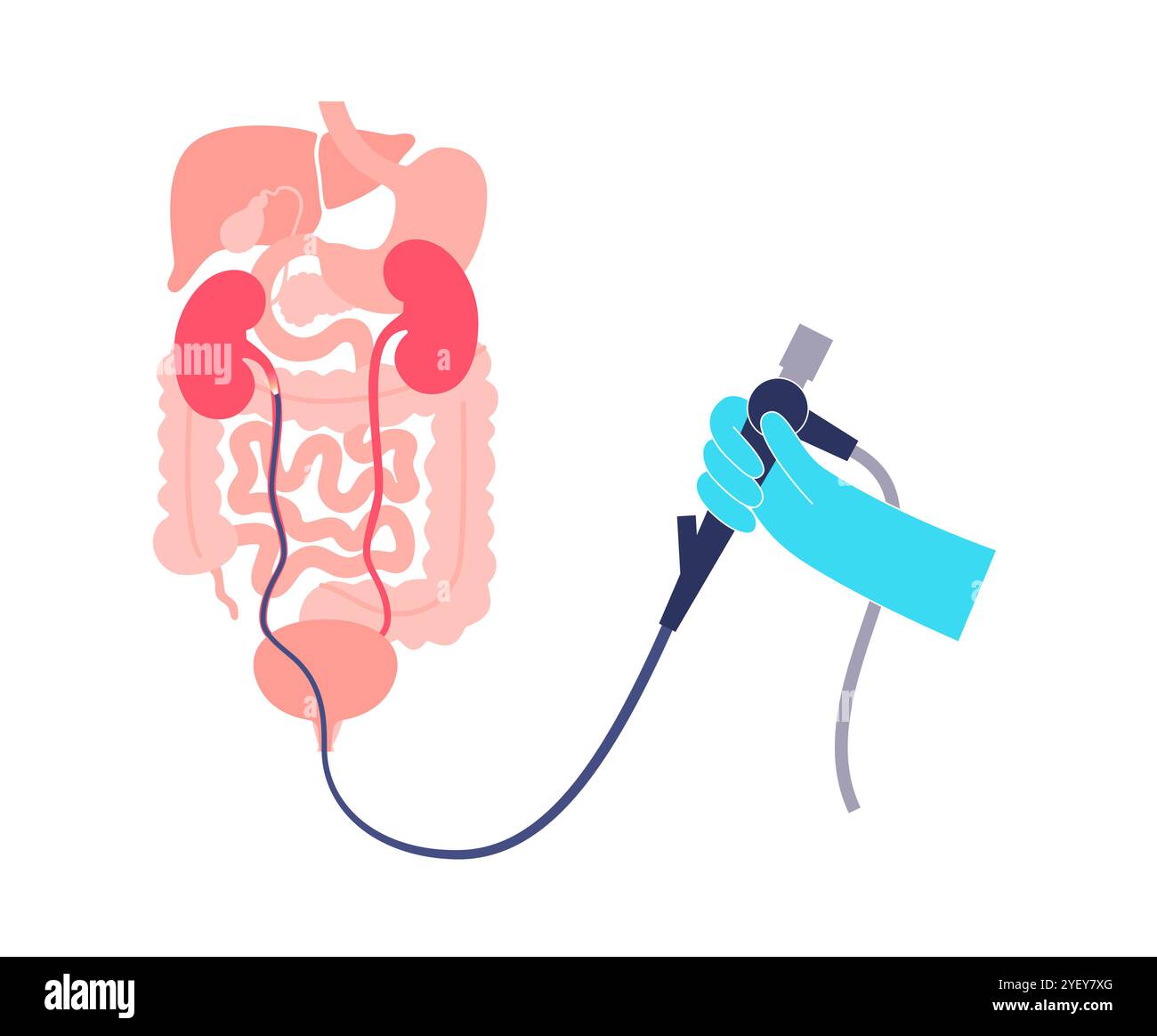 Illustrazione concettuale di una procedura ureteroscopica. Si tratta di una procedura eseguita per esaminare o trattare problemi nel tratto urinario, come i calcoli renali. Foto Stock