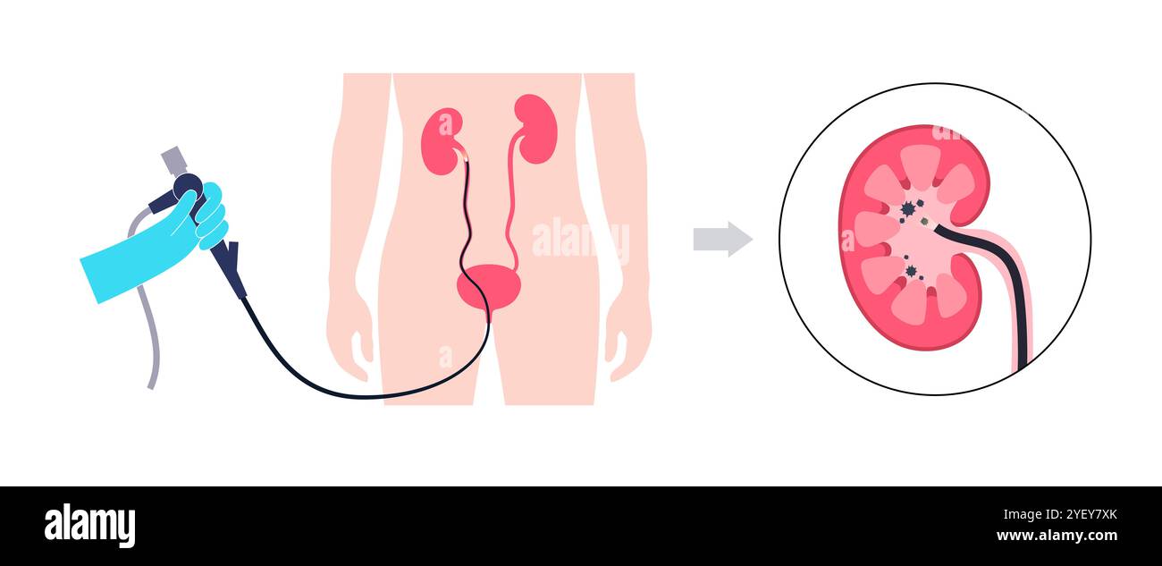 Illustrazione concettuale di una procedura ureteroscopica. Si tratta di una procedura eseguita per esaminare o trattare problemi nel tratto urinario, come i calcoli renali. Foto Stock