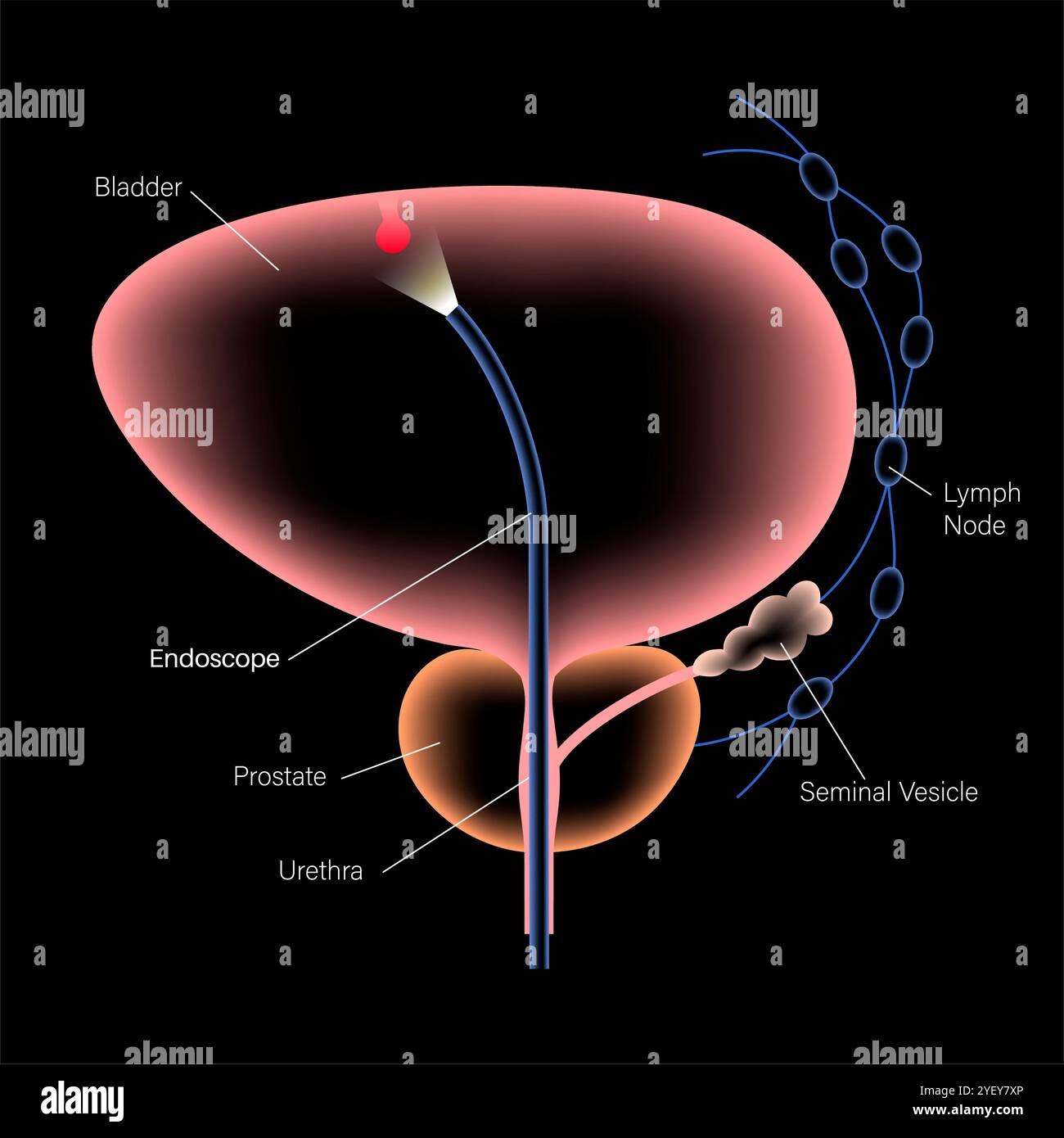 Illustrazione concettuale di una procedura di cistoscopia. Si tratta di una procedura utilizzata per diagnosticare, monitorare e trattare le condizioni che interessano la vescica e l'uretra. Foto Stock
