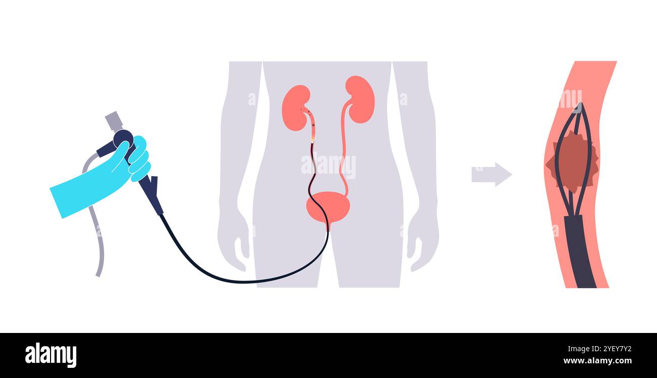 Illustrazione concettuale di una procedura ureteroscopica. Si tratta di una procedura eseguita per esaminare o trattare problemi nel tratto urinario, come i calcoli renali. Foto Stock