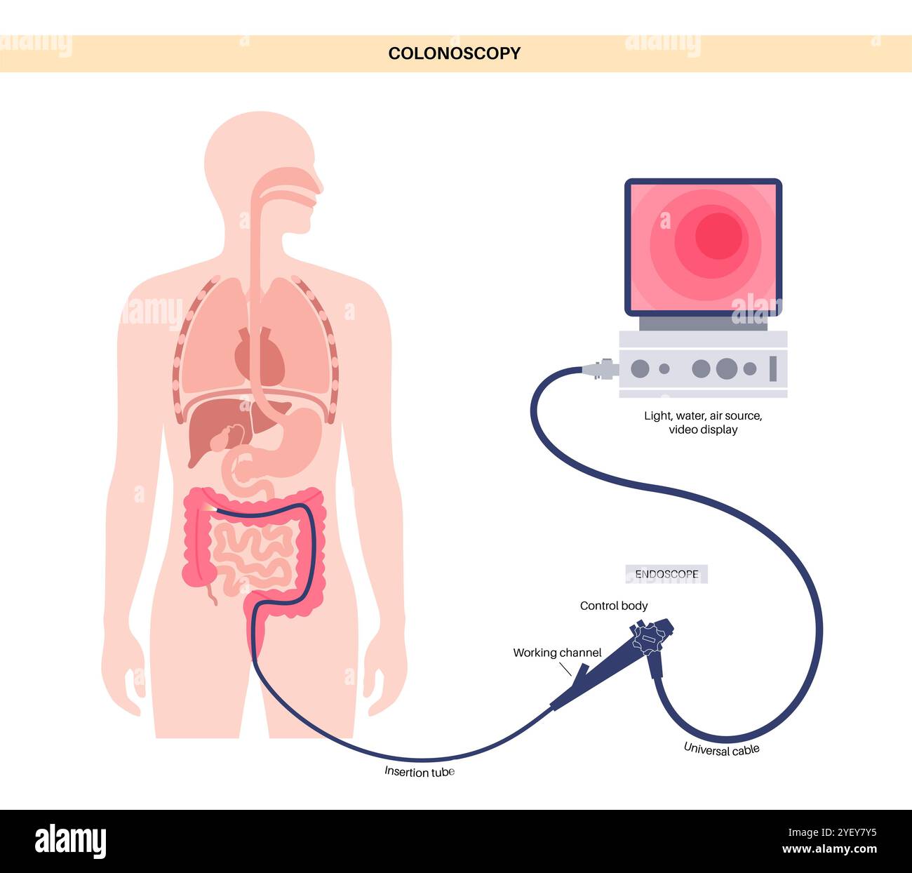 Illustrazione concettuale di una procedura di colonscopia. Questo è un esame dell'interno del vostro intestino crasso, che comprende il colon, il retto e l'ano. Può essere utilizzato per esplorare le possibili cause di dolore addominale, sanguinamento rettale, diarrea cronica e altri problemi gastrointestinali. Viene utilizzato anche per cercare possibili segni di cancro colorettale o polipi. Foto Stock