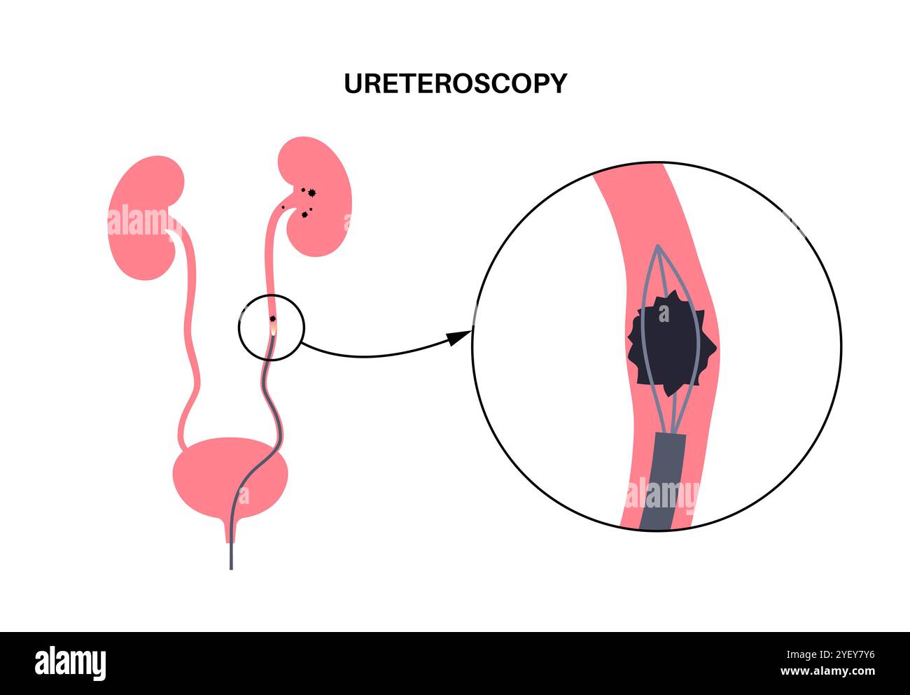 Illustrazione concettuale di una procedura ureteroscopica. Si tratta di una procedura eseguita per esaminare o trattare problemi nel tratto urinario, come i calcoli renali. Foto Stock