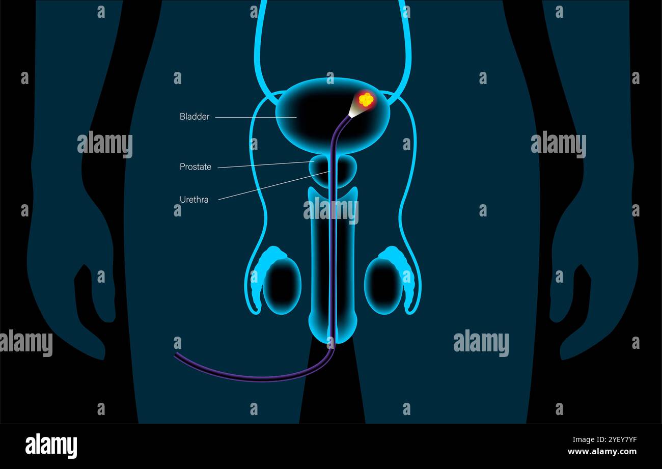 Illustrazione concettuale di una procedura di cistoscopia. Si tratta di una procedura utilizzata per diagnosticare, monitorare e trattare le condizioni che interessano la vescica e l'uretra. Foto Stock