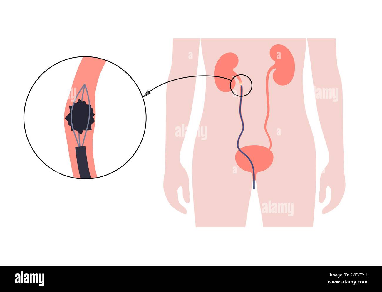 Illustrazione concettuale di una procedura ureteroscopica. Si tratta di una procedura eseguita per esaminare o trattare problemi nel tratto urinario, come i calcoli renali. Foto Stock