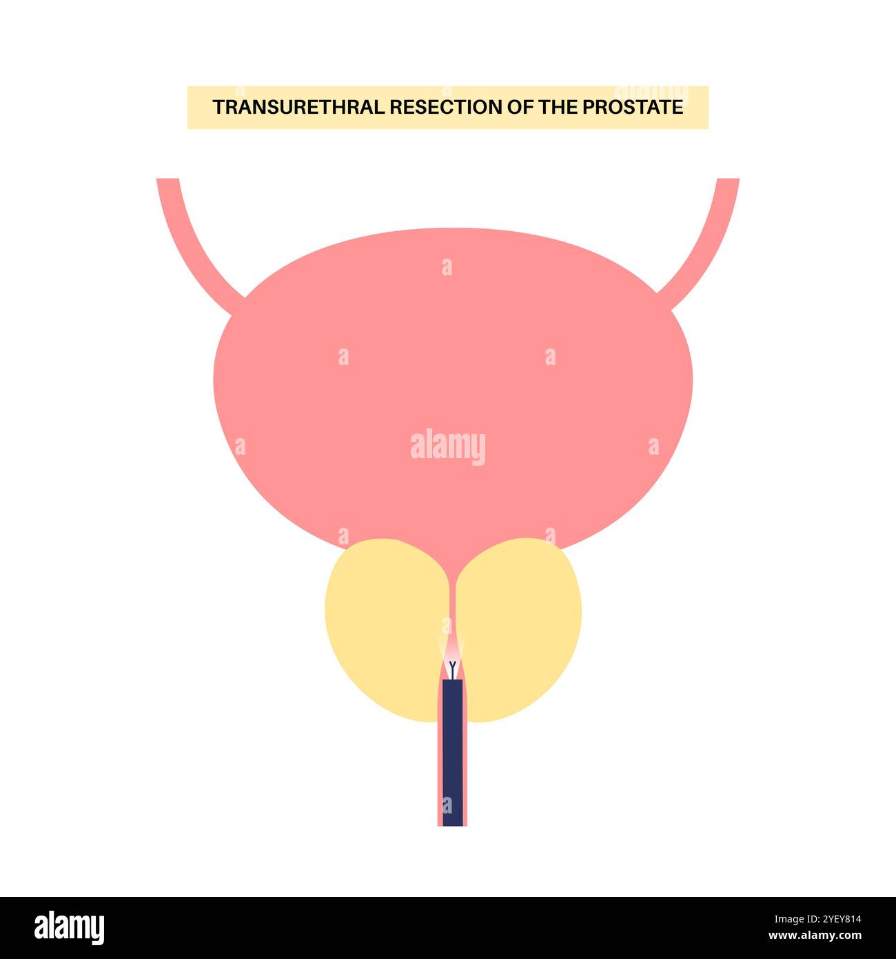 Illustrazione concettuale di una resezione transuretrale della prostata (TURP). Si tratta di una procedura chirurgica che prevede il taglio di una sezione della prostata. Di solito è raccomandato quando l'ingrossamento della prostata provoca sintomi fastidiosi e non risponde al trattamento con farmaci. Foto Stock