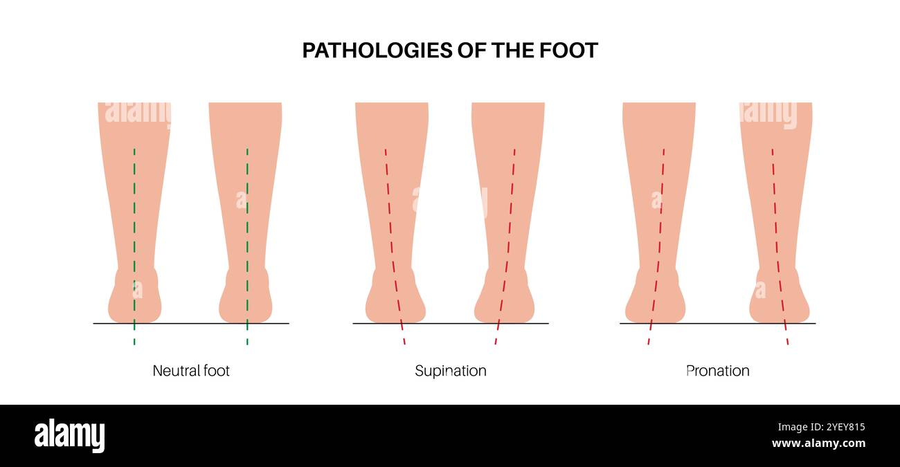 Illustrazione concettuale delle patologie del piede, tra cui neutro, supinazione e pronazione eccessiva. La pronazione descrive il modo in cui un piede rotola verso l'interno e distribuisce l'impatto del peso del corpo al momento dell'atterraggio. In caso di sovrapronazione, i piedi spostano eccessivamente l'impatto. Nella sottopronazione, nota anche come supinazione, i piedi non spostano l'impatto abbastanza lontano. Foto Stock