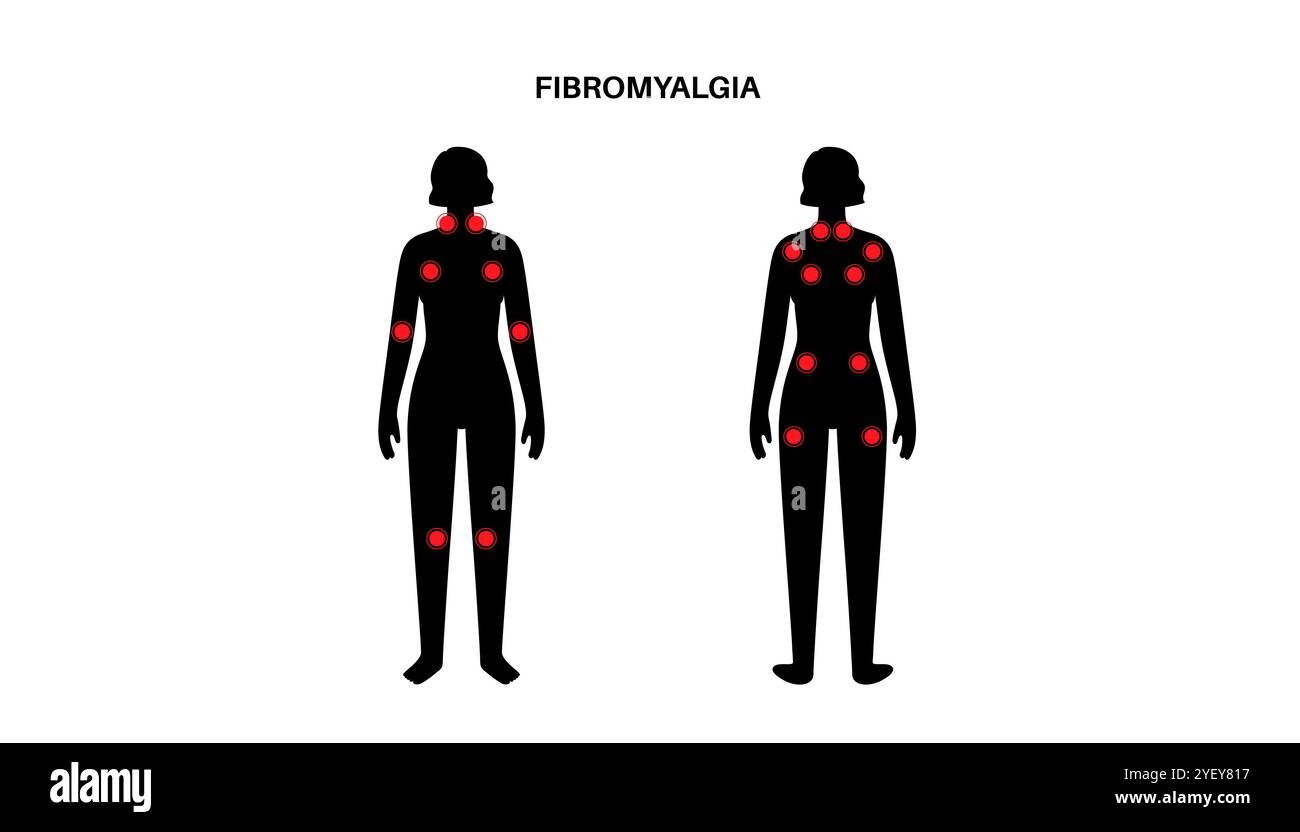 Illustrazione concettuale della fibromialgia. La fibromialgia è una condizione cronica che provoca dolore e tenerezza in tutto il corpo, nonché affaticamento e difficoltà a dormire. La causa esatta è sconosciuta, ma spesso è causata da stress fisico o psicologico. Foto Stock