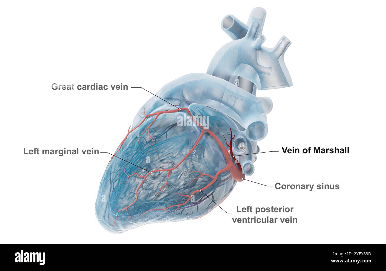 Illustrazione di vene coronarie con la vena di Marshall (rosso scuro) evidenziata. La grande vena cardiaca si vede scorrere attraverso il ventricolo sinistro (camera inferiore) del cuore. La vena di Marshall, nota anche come vena obliqua atriale sinistra, è un residuo embrionale della vena cava superiore. Si ritiene che sia una fonte di trigger di fibrillazione atriale (AF), una frequenza cardiaca irregolare e spesso anormalmente veloce. Per una versione senza etichetta di questa immagine, vedere F043/3534. Foto Stock