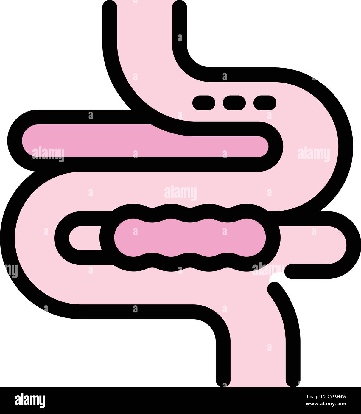 Illustrazione medica che mostra un polipo che cresce nell'intestino umano, che rappresenta lo sviluppo del cancro del colon Illustrazione Vettoriale