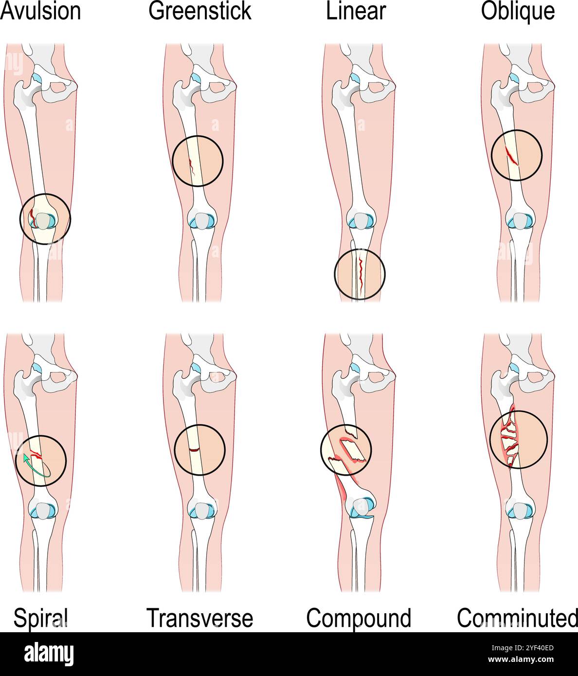 Tipi di frattura ossea. Composto, lineare, trasversale, avulsione, Greenstick, frattura obliqua, a spirale e comminata dell'osso del femore umano. Poster vettoriale Illustrazione Vettoriale