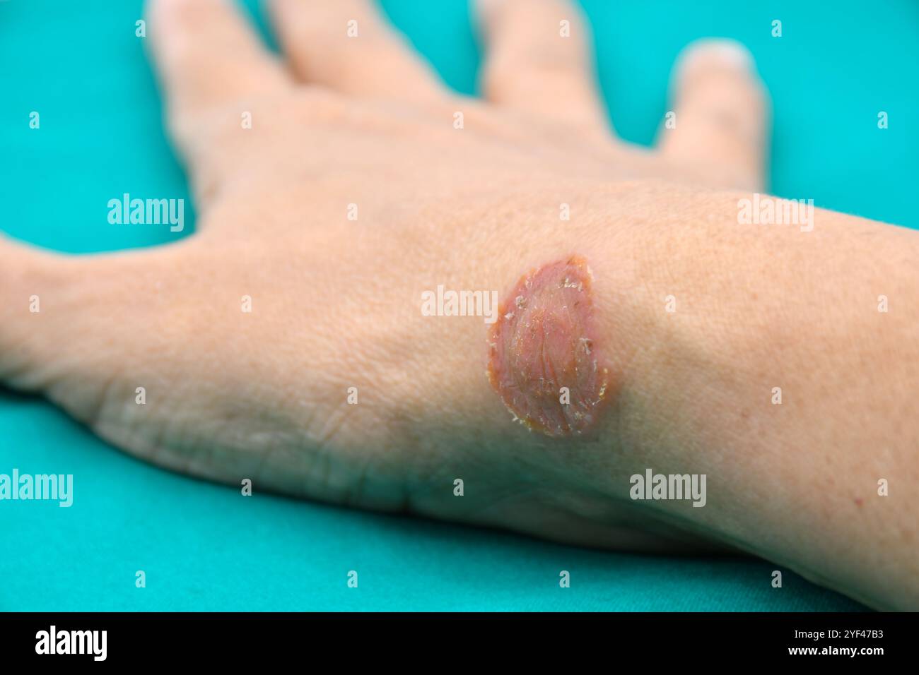 Microsporum canis lesion, un fungo infezioni sulla pelle umana trasmesse per contatto. Il fungo ha una distribuzione mondiale e si fonde infetta la crescita Foto Stock