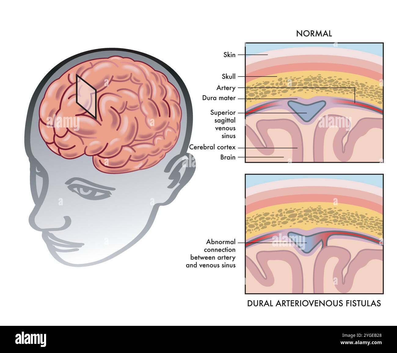 Semplice illustrazione medica che mostra come una fistola arterovenosa durale si verifica nel cervello, con annotazioni. Illustrazione Vettoriale