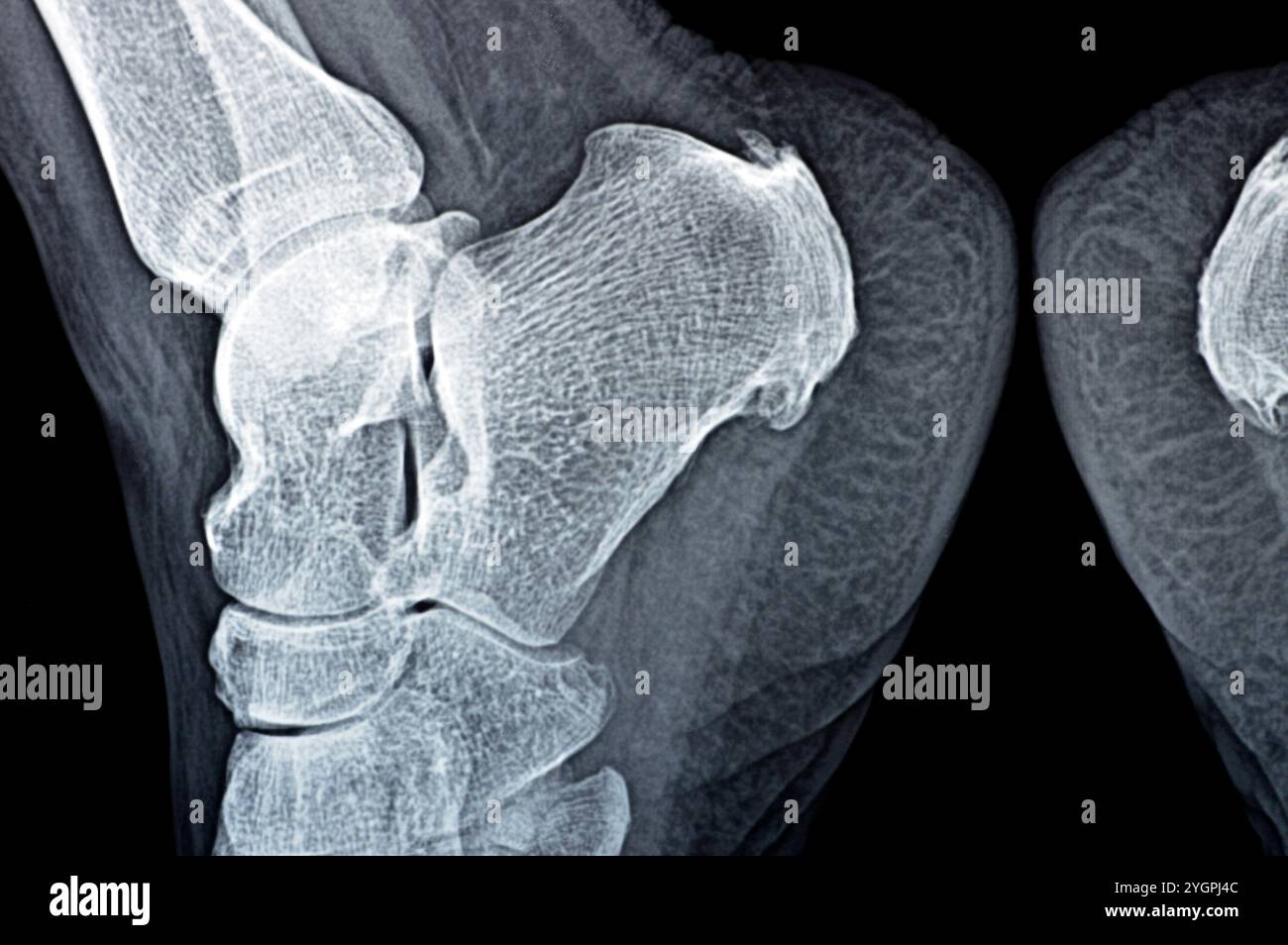 La radiografia normale del piede della paziente mostra lo sperone calcaneale del tallone, la formazione ossea sull'osso del tallone, la fascite plantare, un'infiammazione del fibroso Foto Stock