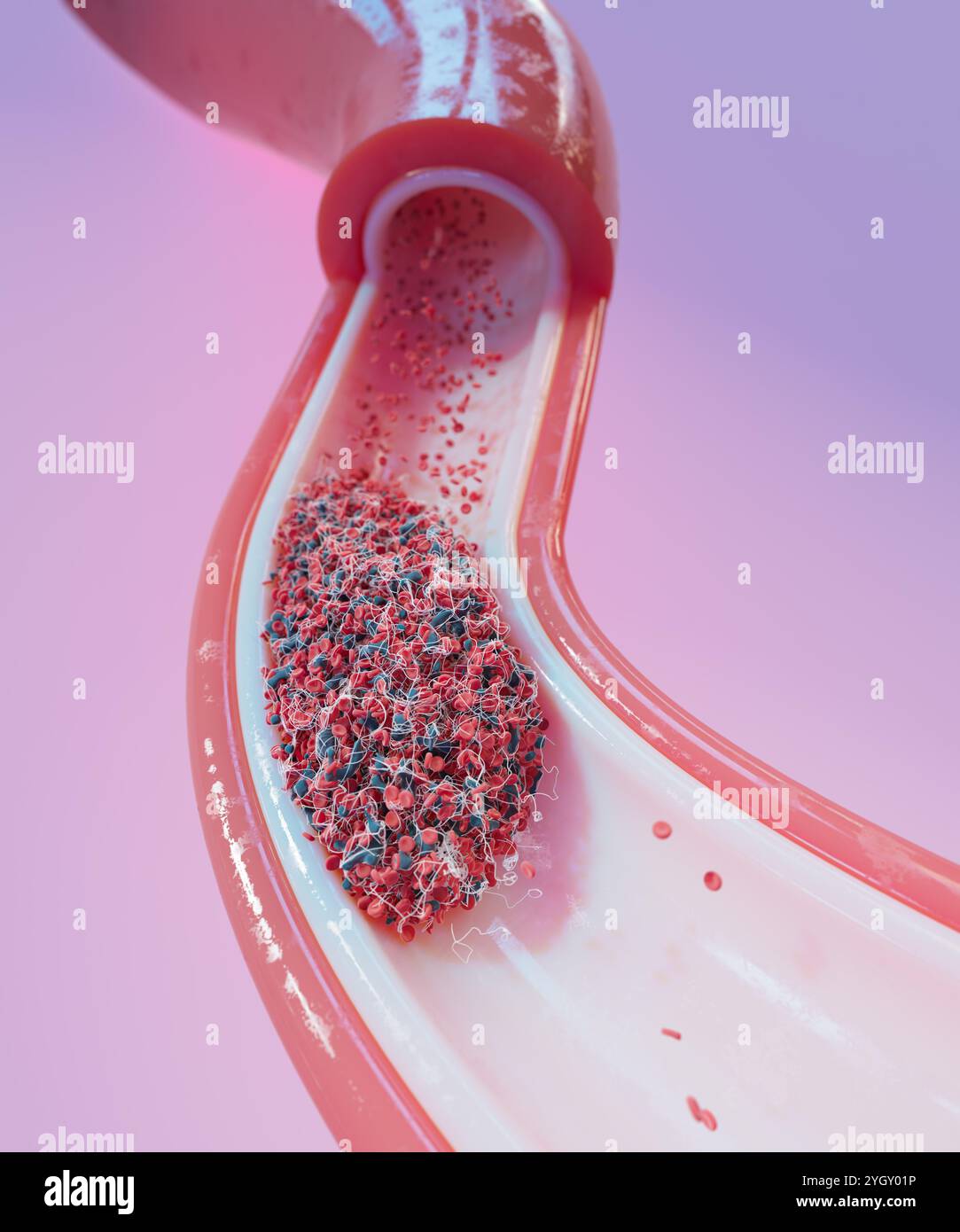 Immagine di un coagulo di sangue (trombo) in un vaso sanguigno. I coaguli si formano in risposta a malattie cardiovascolari o lesioni ai vasi sanguigni. Possono essere fatali se il flusso di sangue è bloccato a un organo vitale, come il cervello. Foto Stock