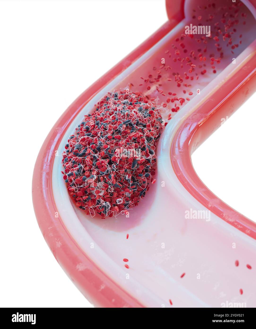 Immagine di un coagulo di sangue (trombo) in un vaso sanguigno. I coaguli si formano in risposta a malattie cardiovascolari o lesioni ai vasi sanguigni. Possono essere fatali se il flusso di sangue è bloccato a un organo vitale, come il cervello. Foto Stock