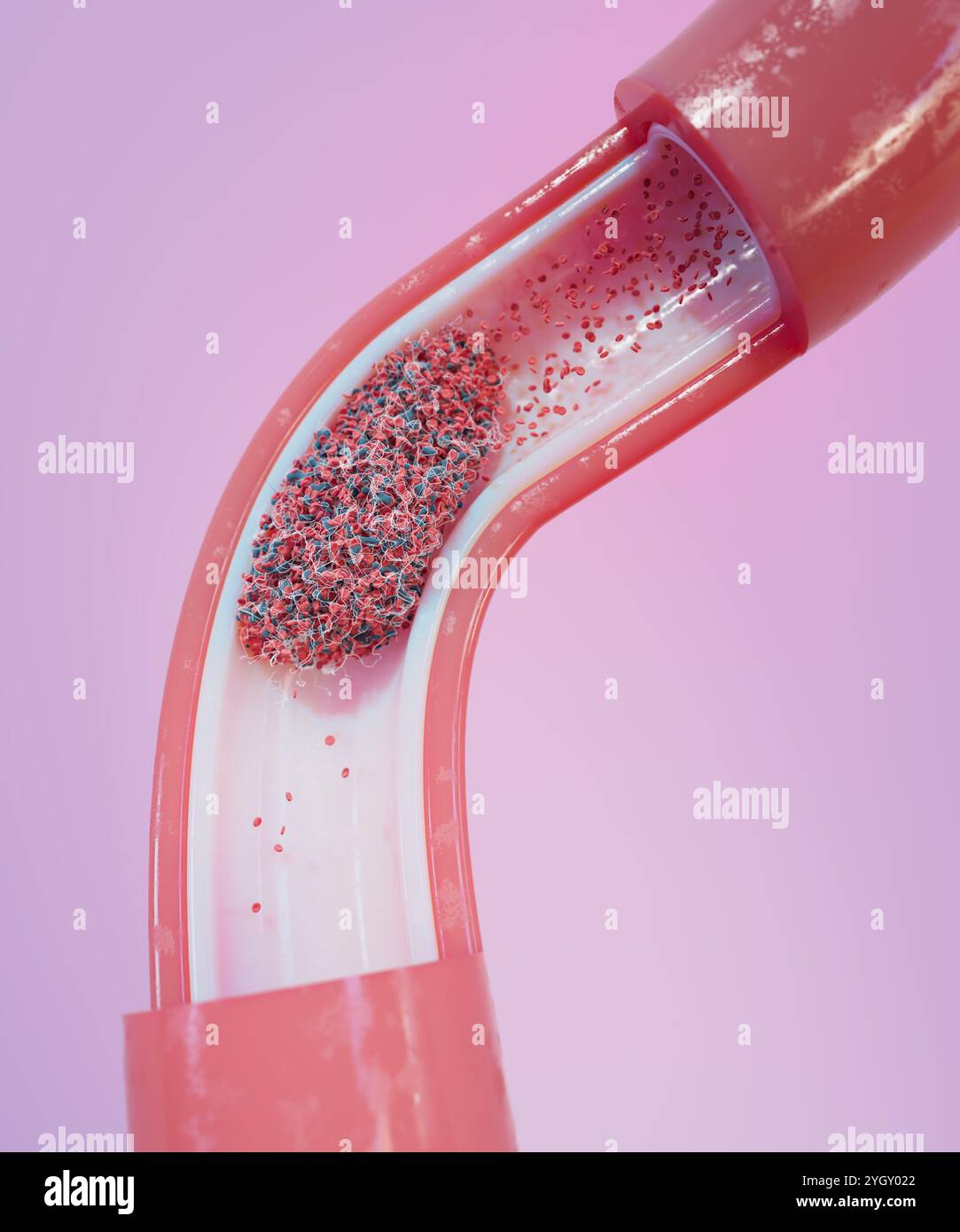 Immagine di un coagulo di sangue (trombo) in un vaso sanguigno. I coaguli si formano in risposta a malattie cardiovascolari o lesioni ai vasi sanguigni. Possono essere fatali se il flusso di sangue è bloccato a un organo vitale, come il cervello. Foto Stock