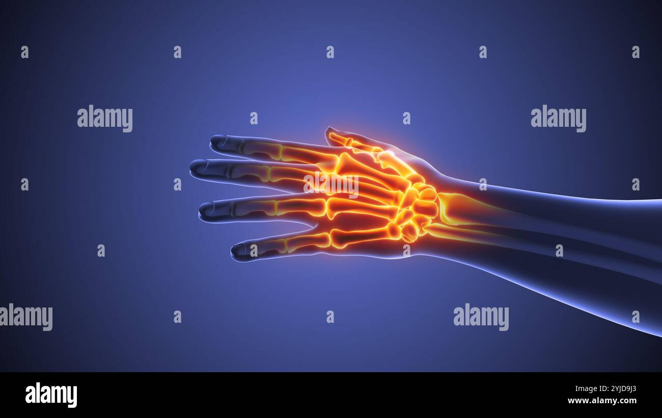 L'anatomia del dolore alla mano scheletrica Foto Stock