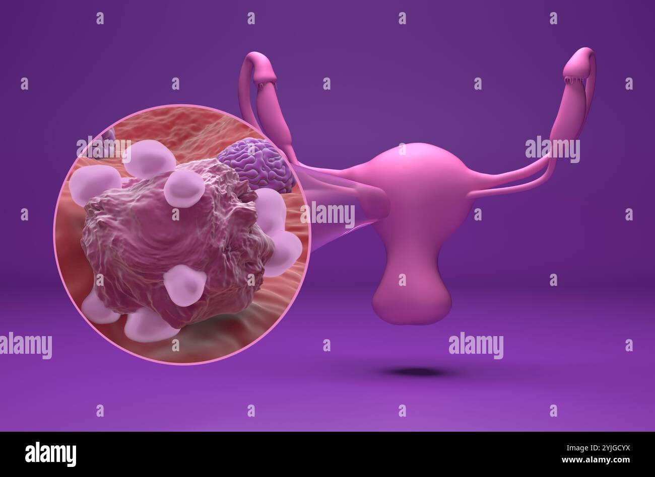 Cancro ovarico - Vista isometrica illustrazione 3d. Foto Stock