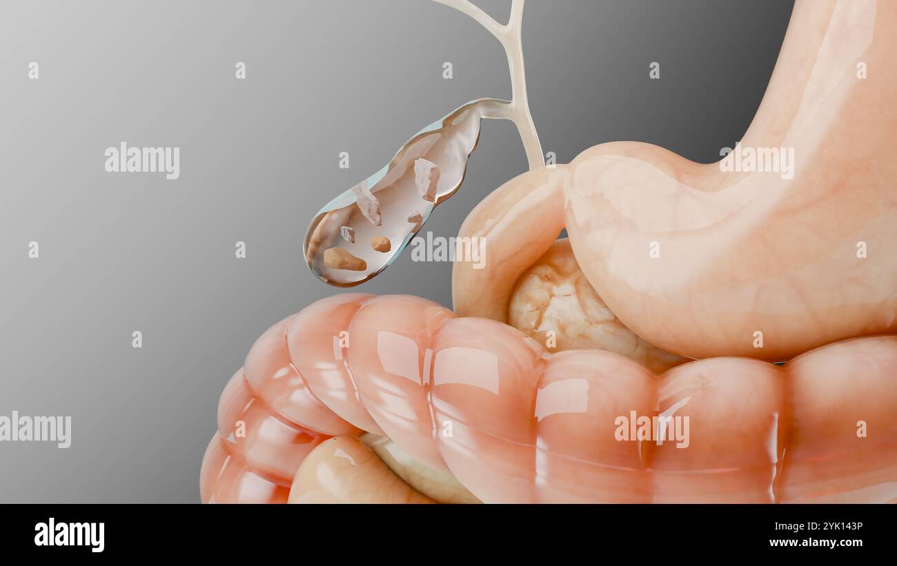 Calcoli biliari nel dotto biliare gallbladderand, silhouette umana e anatomia degli organi circostanti, fegato e cistifellea con pietre, rendering 3D realistico Foto Stock