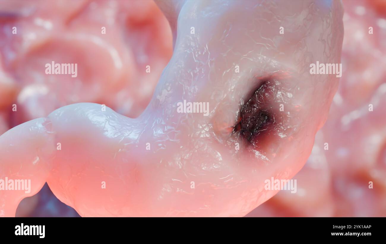 Cancro allo stomaco. Stadi crescita tumorale nell'apparato digerente, anatomia dell'ulcera peptica, cellula di attacco del cancro. concetto di malattia gastrica. sintomi, può maligno Foto Stock