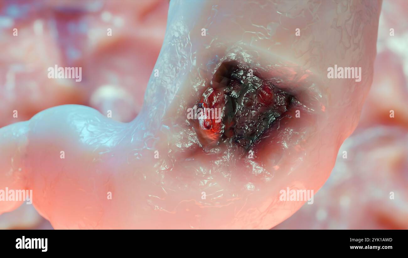 Cancro allo stomaco. Stadi crescita tumorale nell'apparato digerente, anatomia dell'ulcera peptica, cellula di attacco del cancro. concetto di malattia gastrica. sintomi, può maligno Foto Stock