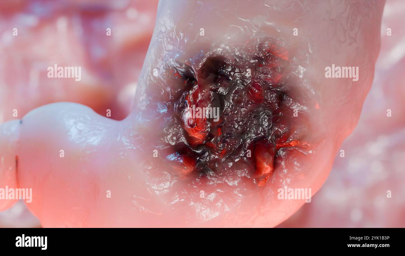 Cancro allo stomaco. Stadi crescita tumorale nell'apparato digerente, anatomia dell'ulcera peptica, cellula di attacco del cancro. concetto di malattia gastrica. sintomi, può maligno Foto Stock