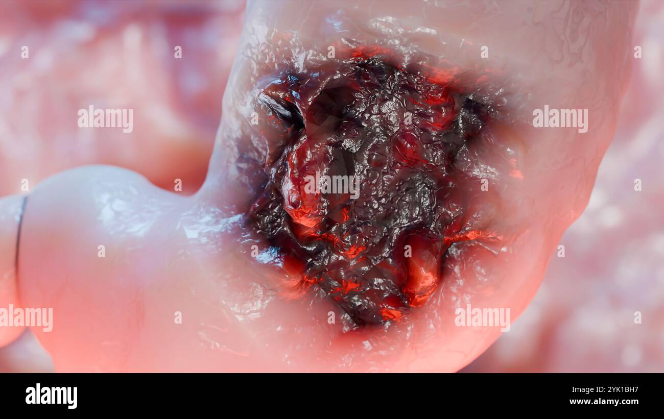 Cancro allo stomaco. Stadi crescita tumorale nell'apparato digerente, anatomia dell'ulcera peptica, cellula di attacco del cancro. concetto di malattia gastrica. sintomi, può maligno Foto Stock