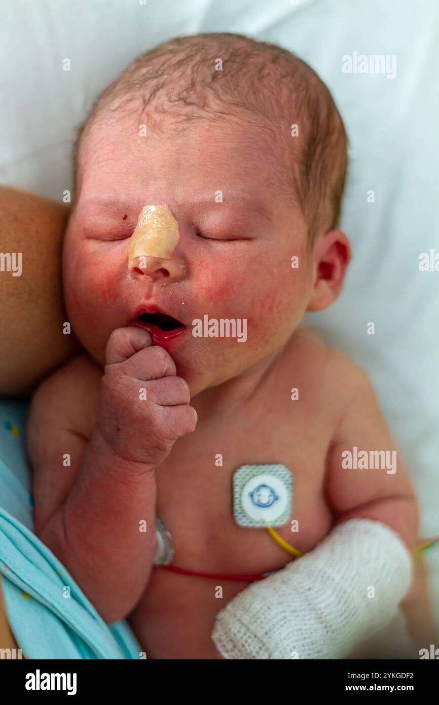 Neonato in ospedale con sensori di monitoraggio e indumento protettivo Foto Stock