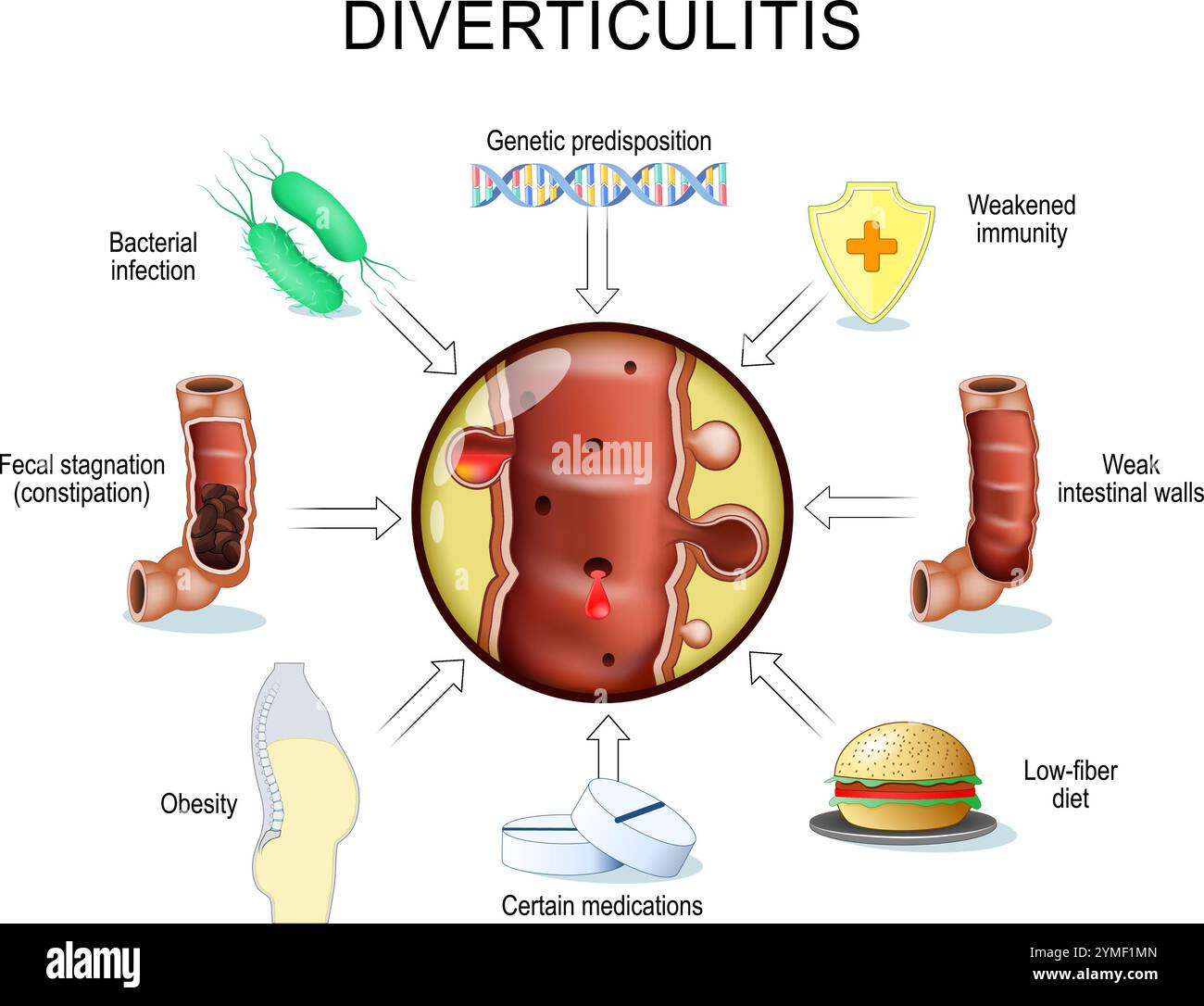 Fattori scatenanti della progressione della diverticolite. Peristalsi gastrointestinale e costipazione cronica. Disturbi della motilità intestinale. Primo piano di una parte di una grande i. Illustrazione Vettoriale