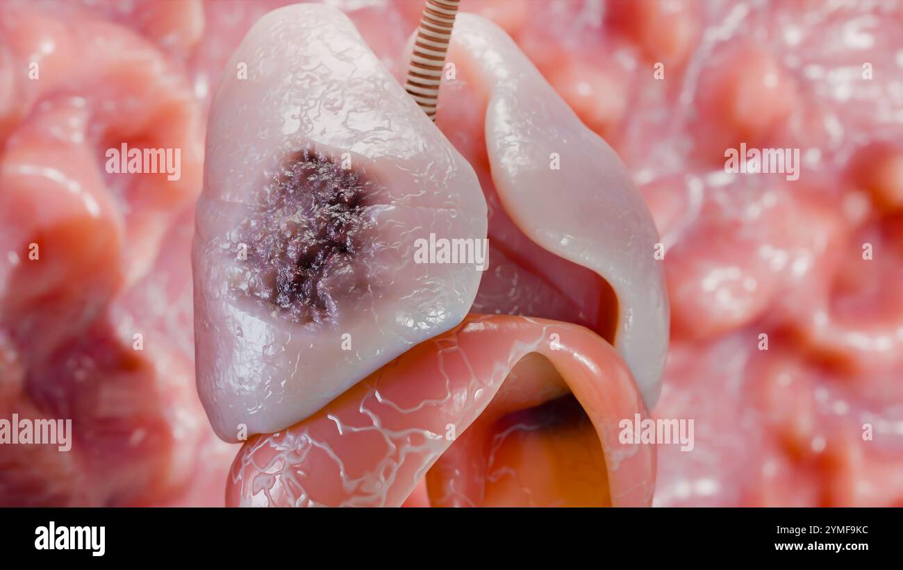 Polmonite malattia, polmoni sani e polmoni malattia, cancro polmonare umano, fumatori di sigaretta malattia polmonare, tumori maligni cancerosi in crescita e spreadina Foto Stock