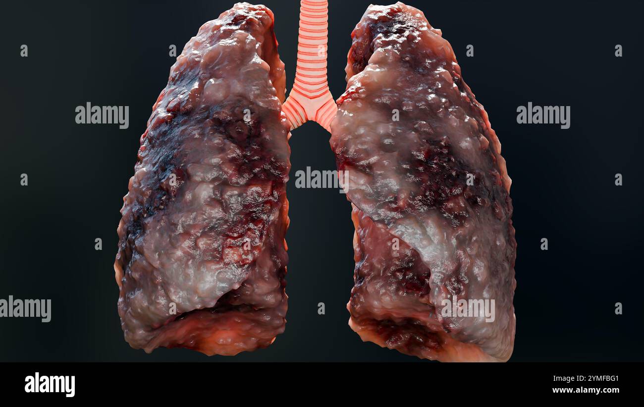 Polmonite malattia, polmoni sani e polmoni malattia, cancro polmonare umano, fumatori di sigaretta malattia polmonare, tumori maligni cancerosi in crescita e spreadina Foto Stock
