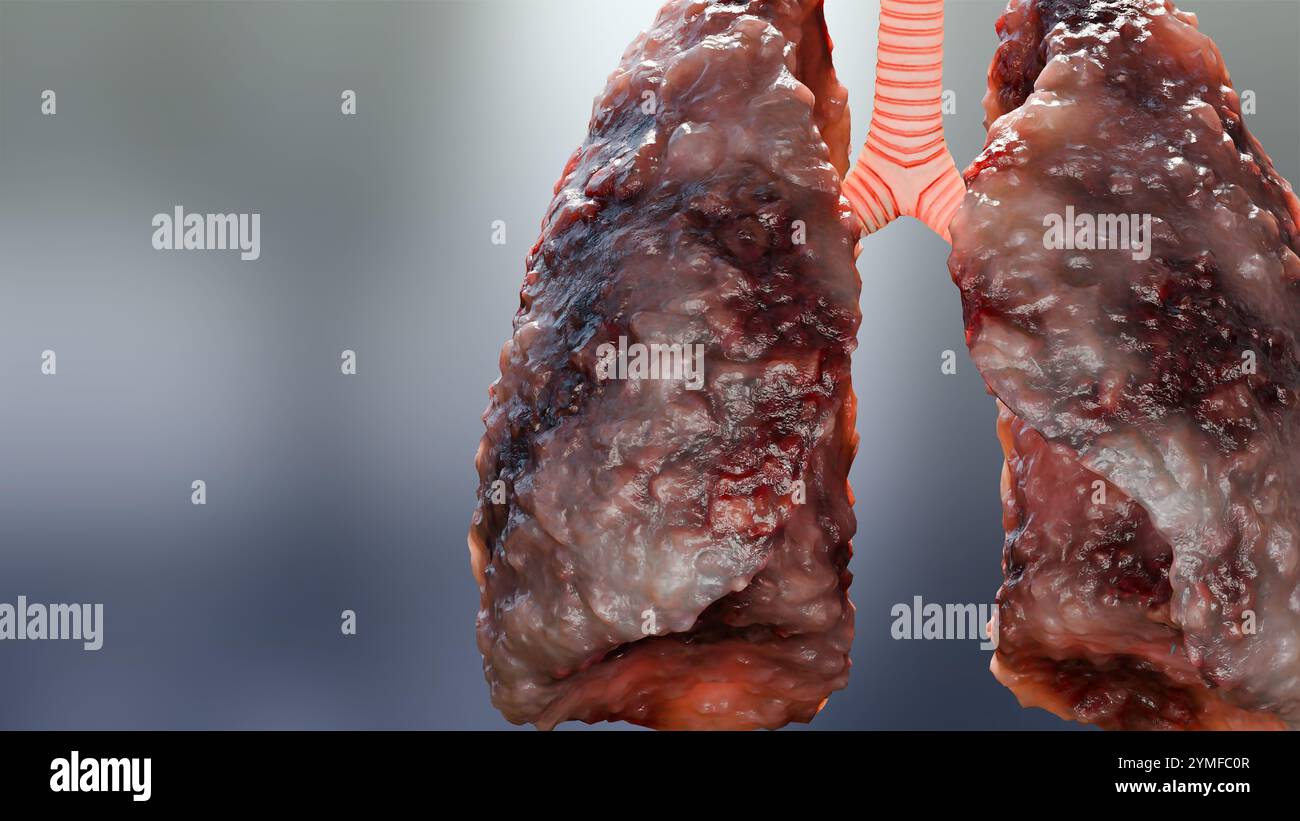 Polmonite malattia, polmoni sani e polmoni malattia, cancro polmonare umano, fumatori di sigaretta malattia polmonare, tumori maligni cancerosi in crescita e spreadina Foto Stock