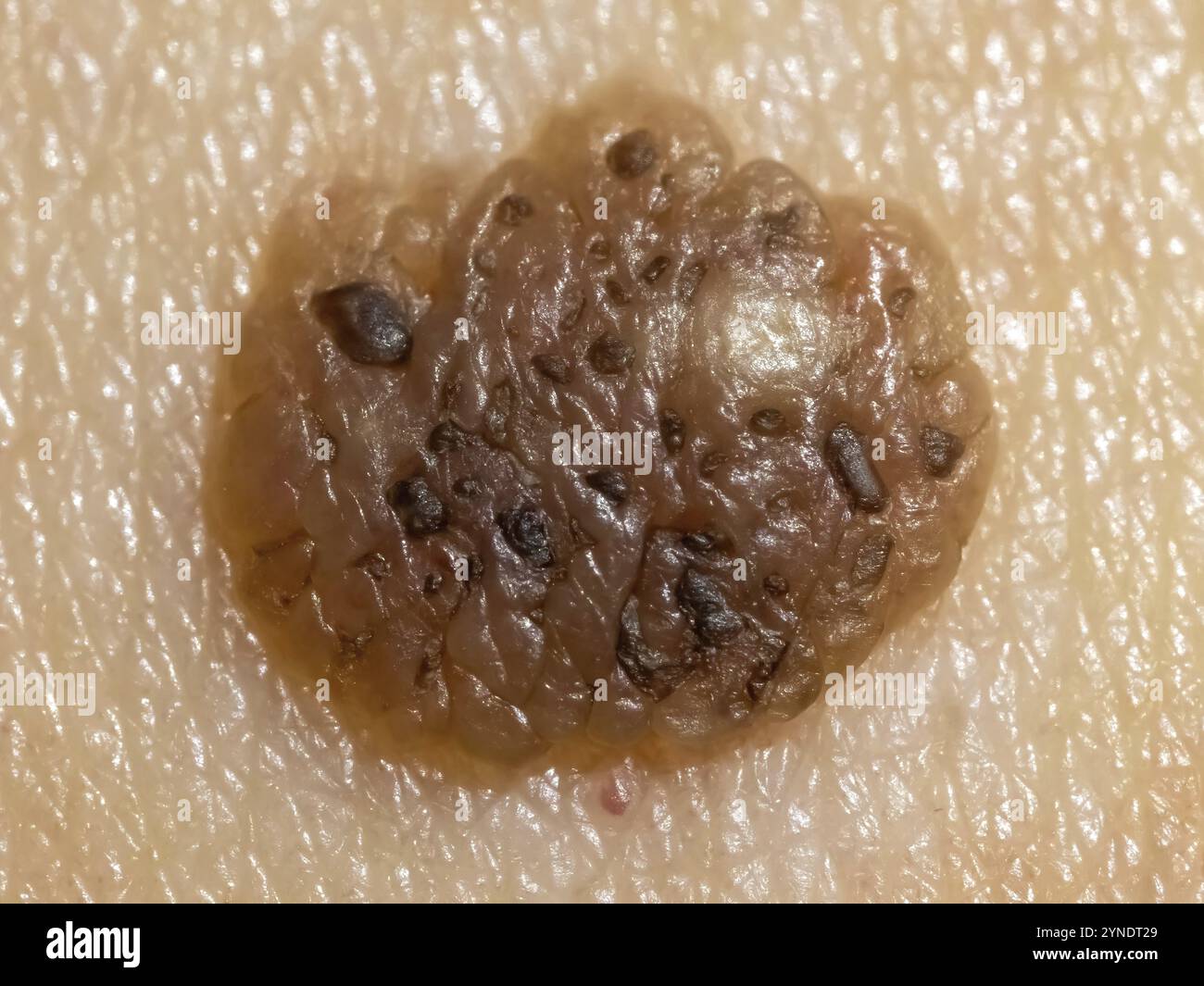 Una vista macro dettagliata di una talpa con potenziali indicazioni di melanoma maligno. Concetto: Cancro della pelle Foto Stock