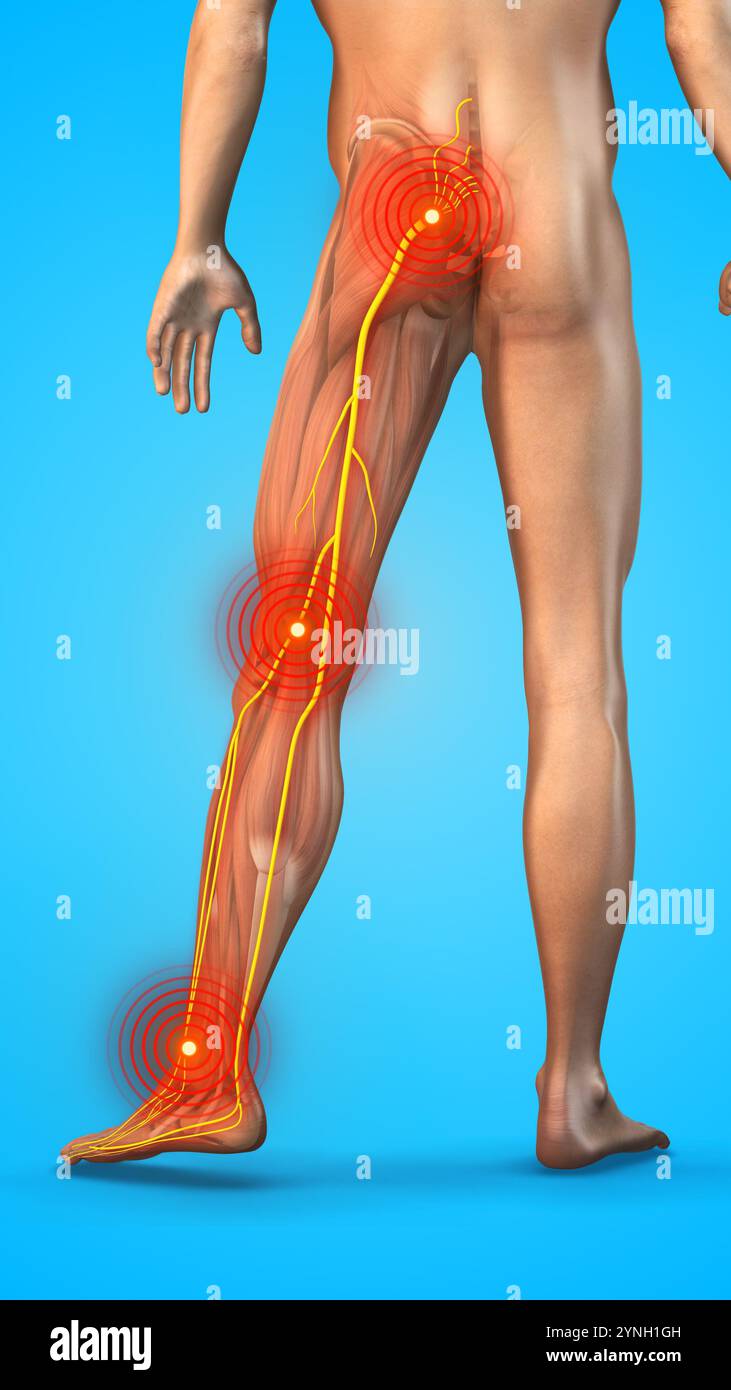 Posizioni dolore sciatica su sfondo blu Foto Stock