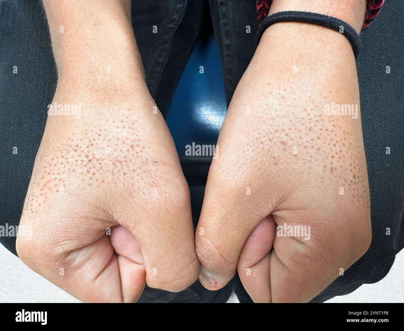 Pelle secca, nota anche come xerosi o xeroderma, sulle mani di un paziente che viene trattato con il farmaco retinoide isotretinoina. Foto Stock