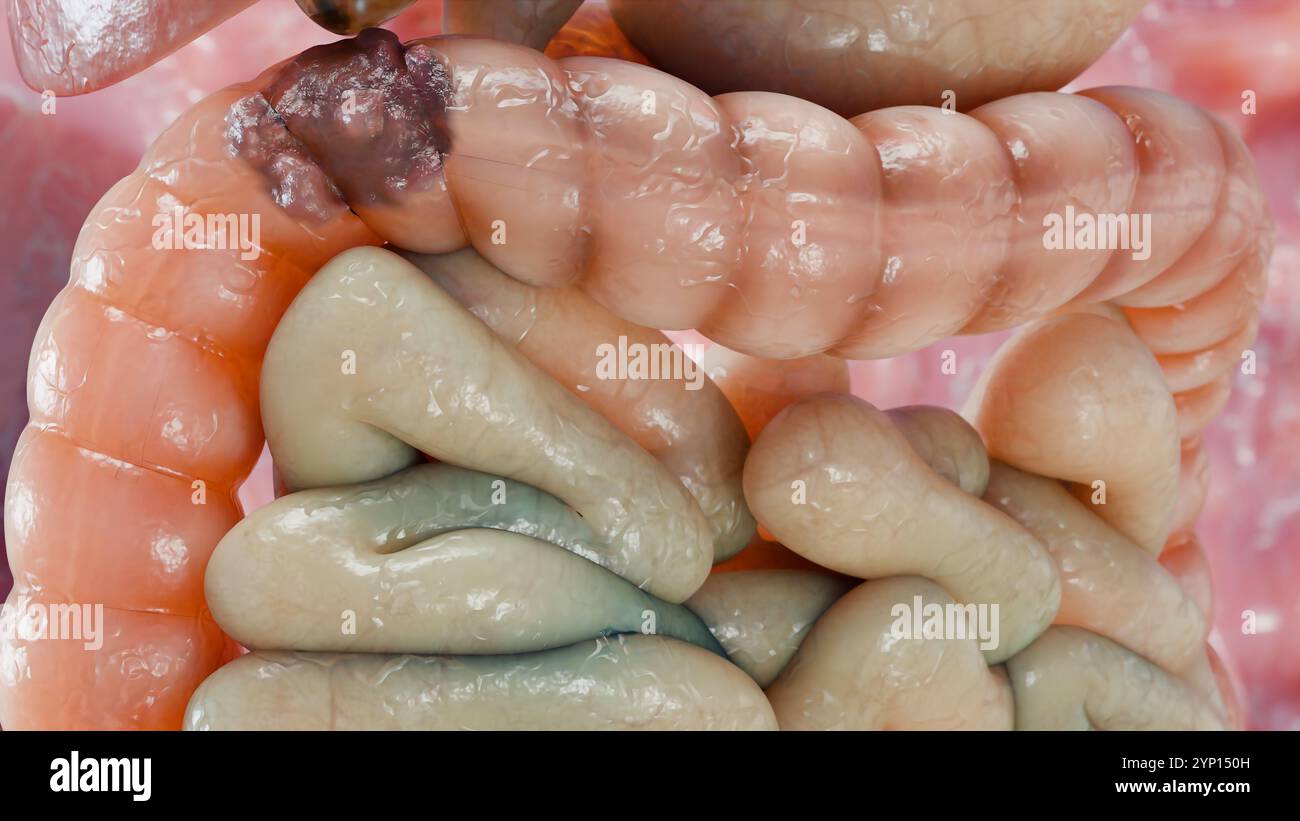 Cancro colorettale, tumore maligno dell'intestino, endoscopio all'interno della colonscopia, intestino intestinale, rimozione dei polipi del colon, ricerca dei polipi del colon, polipectomia, Foto Stock