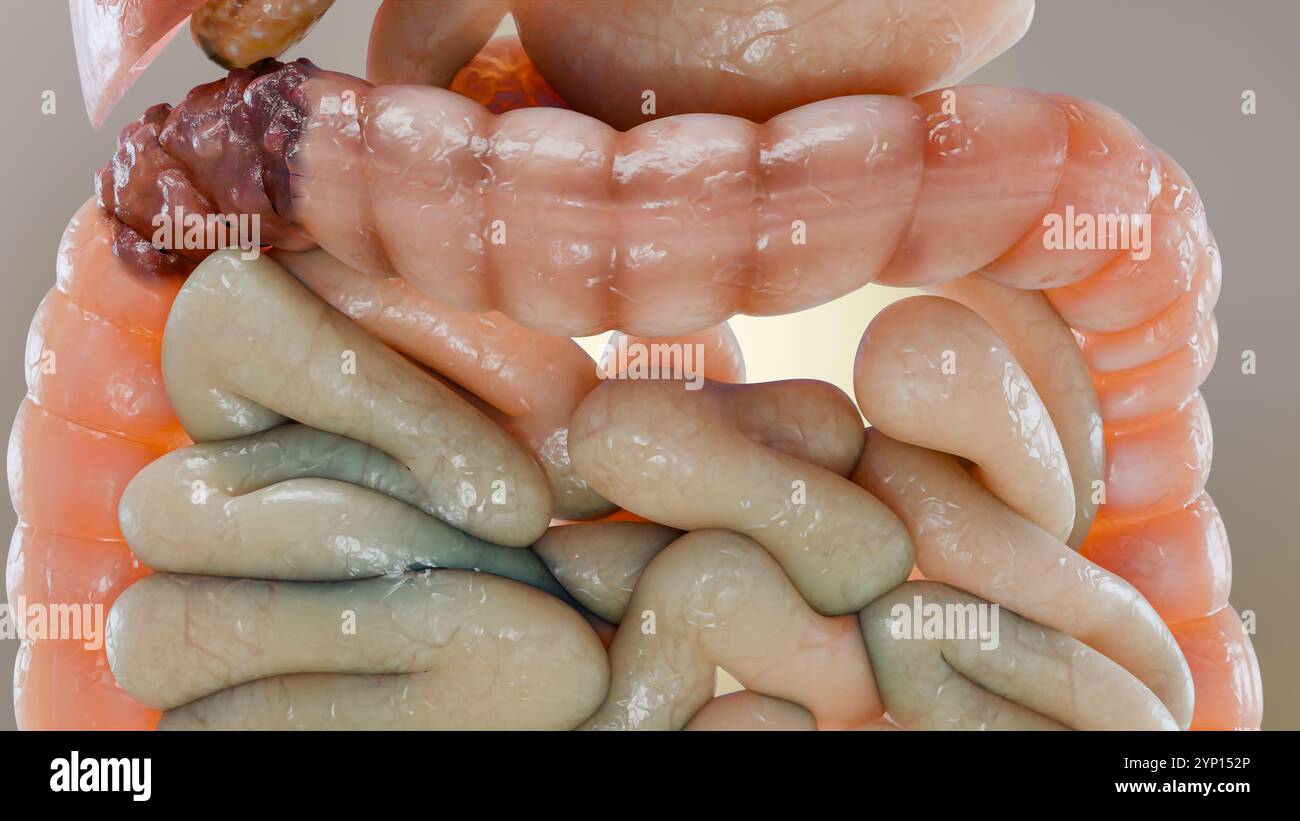 Cancro colorettale, tumore maligno dell'intestino, endoscopio all'interno della colonscopia, intestino intestinale, rimozione dei polipi del colon, ricerca dei polipi del colon, polipectomia, Foto Stock