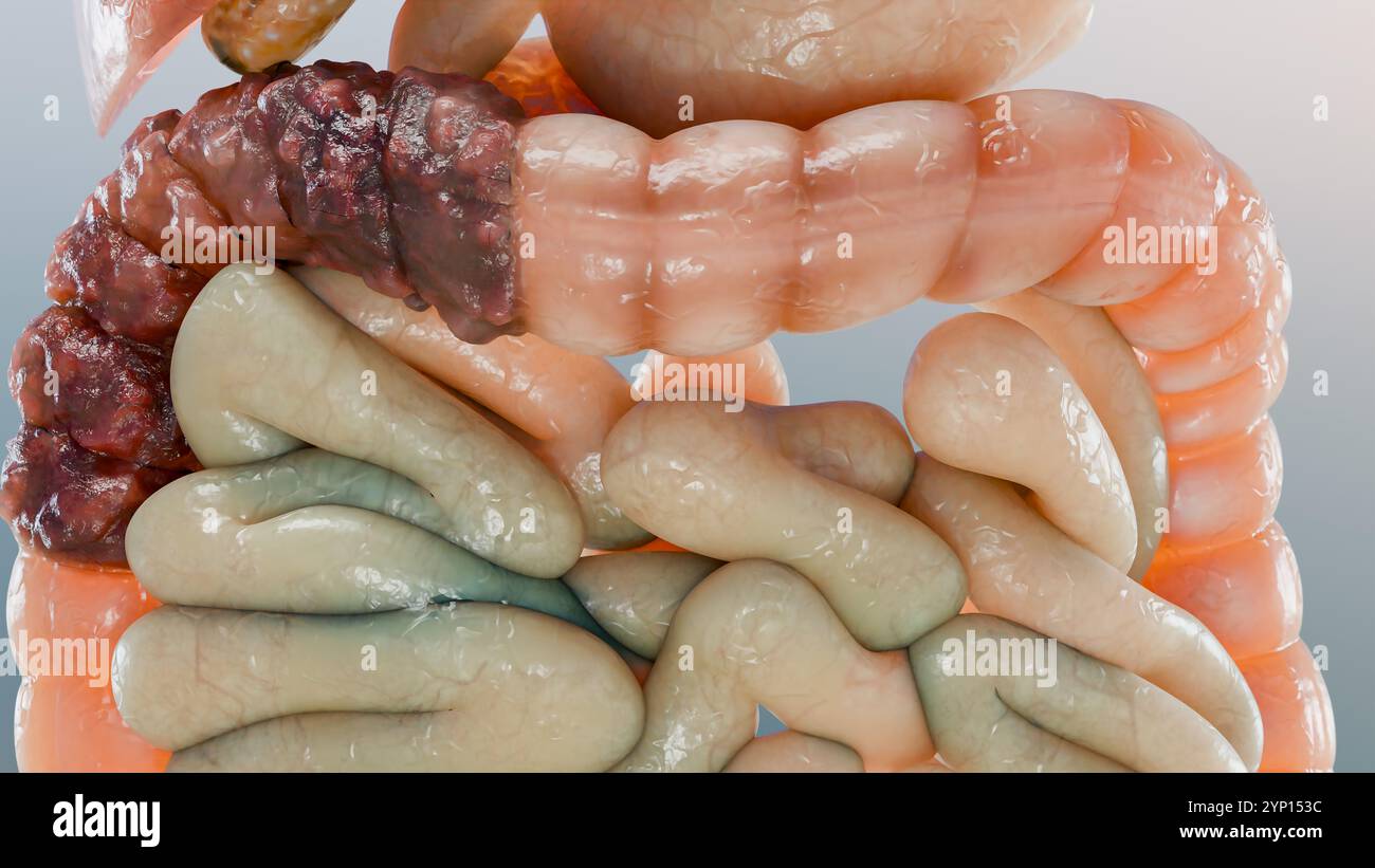 Cancro colorettale, tumore maligno dell'intestino, endoscopio all'interno della colonscopia, intestino intestinale, rimozione dei polipi del colon, ricerca dei polipi del colon, polipectomia, Foto Stock