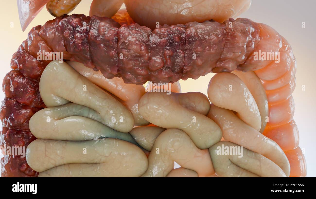 Cancro colorettale, tumore maligno dell'intestino, endoscopio all'interno della colonscopia, intestino intestinale, rimozione dei polipi del colon, ricerca dei polipi del colon, polipectomia, Foto Stock
