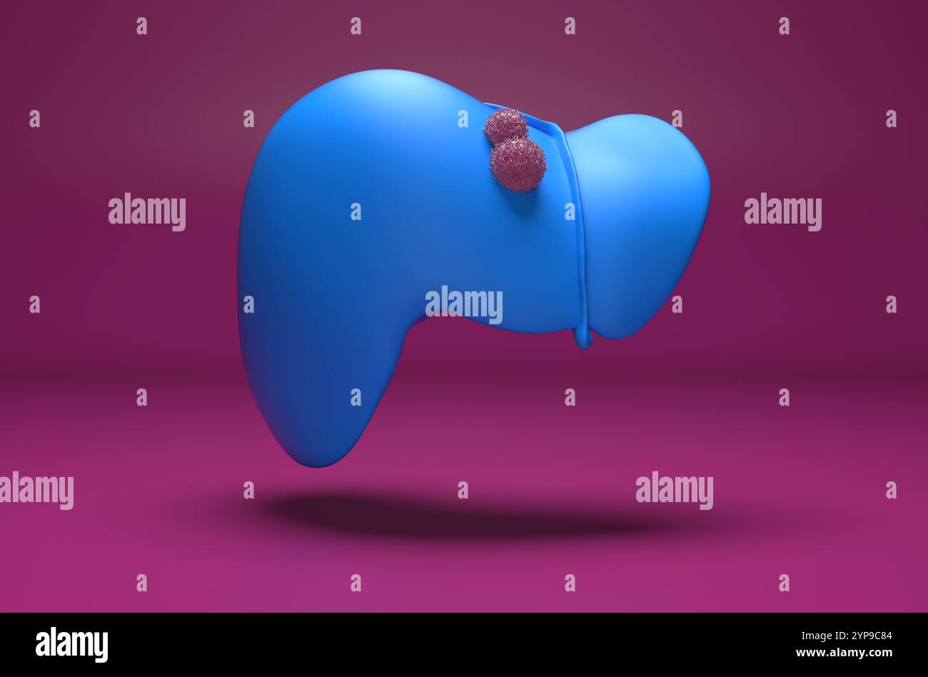 Cancro del fegato - Vista isometrica illustrazione 3d. Foto Stock
